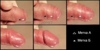 foreskin.jpg