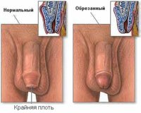 circumcision1.jpg
