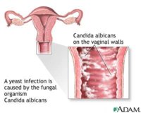172741_yeast_infections.jpg