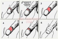 foreskin2.jpg