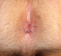 300px_Anus_m.jpg